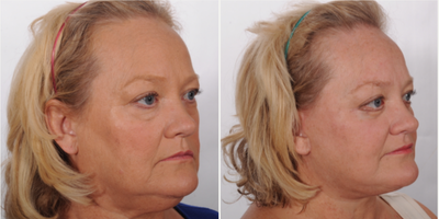 Facelift before and after photo