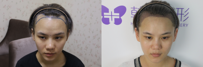 Hair Transplant before and after photo