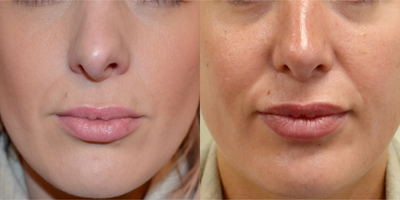 Revision Rhinoplasty before and after photo
