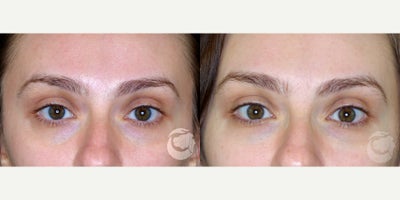 Belotero before and after photo
