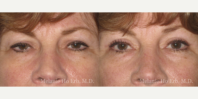 Eyelid Surgery before and after photo