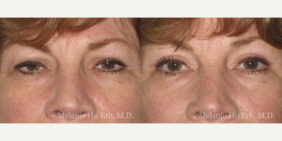 Eyelid Surgery before and after photo
