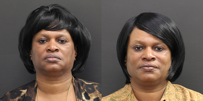 Lip Reduction before and after photo
