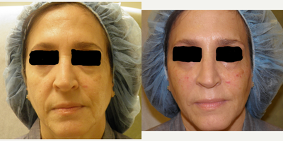 Liquid Facelift before and after photo