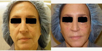 Liquid Facelift before and after photo