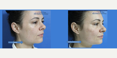 Nonsurgical Facelift before and after photo