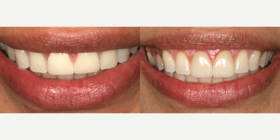 Gum Lift before and after photo