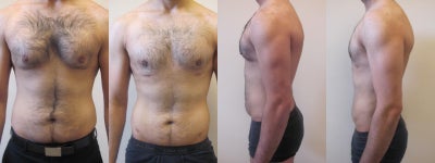 Gynecomastia Surgery before and after photo