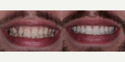 Invisalign before and after photo