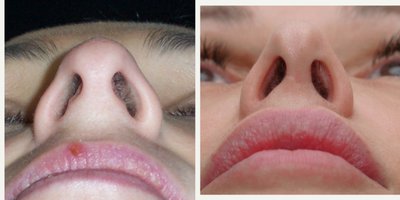 Revision Rhinoplasty before and after photo