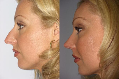 Rhinoplasty before and after photo