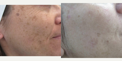 Skin Rejuvenation before and after photo