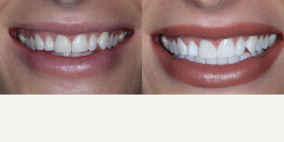 Zoom Whitening before and after photo