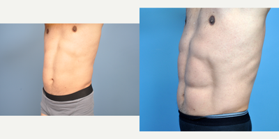 Abdominal Etching before and after photo