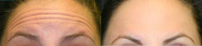 Botox before and after photo