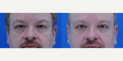 Eyelid Surgery before and after photo