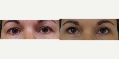 Eyelid Surgery before and after photo