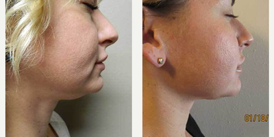 Kybella before and after photo