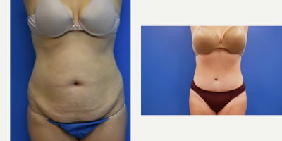 Vaser Liposuction before and after photo
