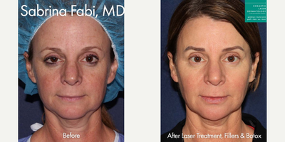 Botox before and after photo