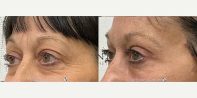 Facial Fat Transfer before and after photo
