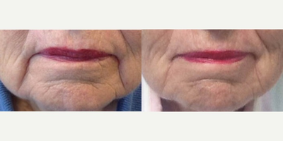 Restylane Lyft before and after photo