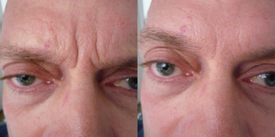 Botox before and after photo