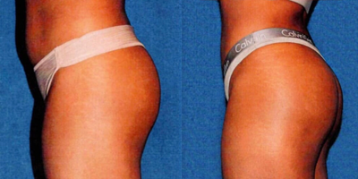 Brazilian Butt Lift before and after photo