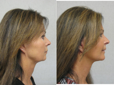 Neck Lift before and after photo