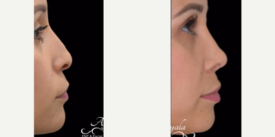 Revision Rhinoplasty before and after photo