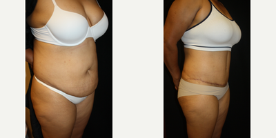 Tummy Tuck before and after photo