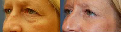 Eyelid Surgery before and after photo