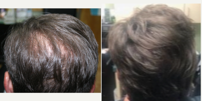 Hair Loss Treatment before and after photo