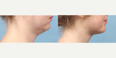 Kybella before and after photo