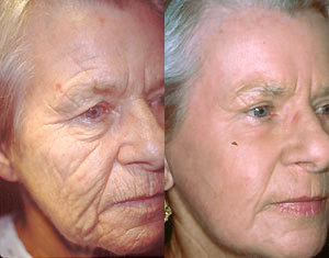 Laser Resurfacing before and after photo