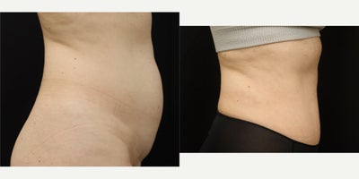 Liposuction before and after photo