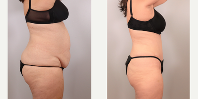 Tummy Tuck before and after photo