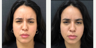 Botox before and after photo
