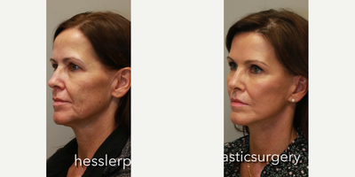 Brow Lift before and after photo