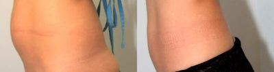 CoolSculpting before and after photo
