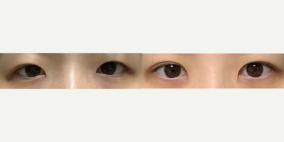 Double Eyelid Surgery before and after photo