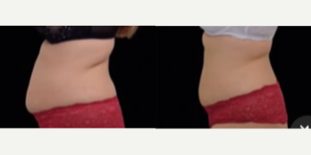 Emsculpt before and after photo