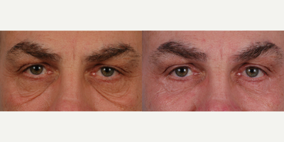 Eyelid Surgery before and after photo