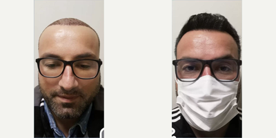 FUE Hair Transplant before and after photo