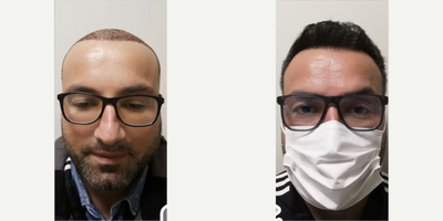 FUE Hair Transplant before and after photo