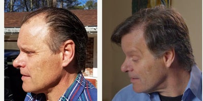 FUE Hair Transplant before and after photo
