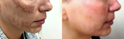 Laser Resurfacing before and after photo