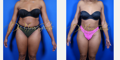 Liposuction before and after photo