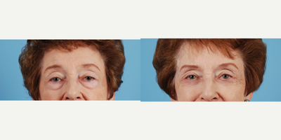 Eyelid Surgery before and after photo