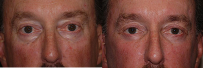 Eyelid Surgery before and after photo